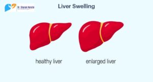 Learn about the causes, symptoms, and treatment liver swelling. Get expert care and guidance from a leading Liver Transplant Surgeon in Pune.